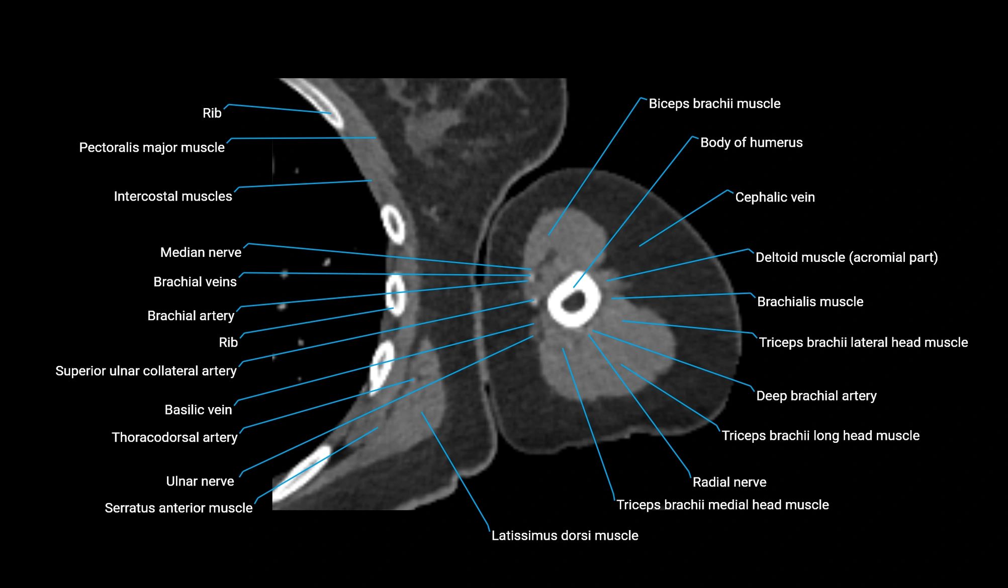 CT upper arm axial  cross sectional anatomy labelled radiology image -00224.webp